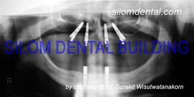 Upper and Lower All-on-4 Implants