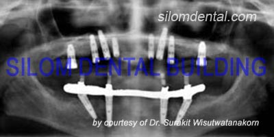 All-on-4 Implants + implants support bridge