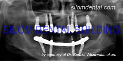 All-on-4 Implants + implants support bridge
