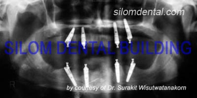 Upper and Lower All-on-4 Implants