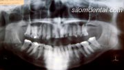dental crowns case at Silom Dental Building Clinic