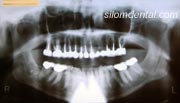 dental crowns case at Silom Dental Building Clinic