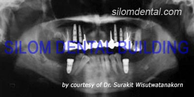 dental implant support bridge