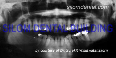 Dental Implants SLActive