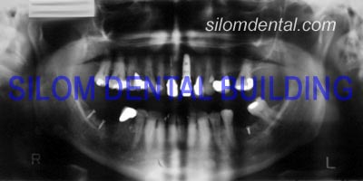 Upper All-on-4 Implants
