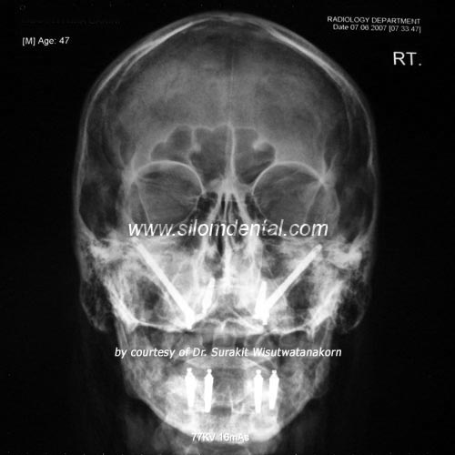 Upper Zygoma and Lower All-on-4