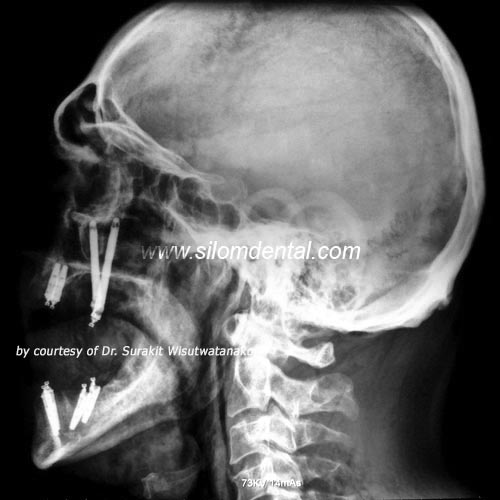 Upper Zygoma and Lower All-on-4