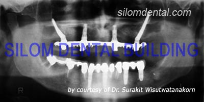 zygomatic implant